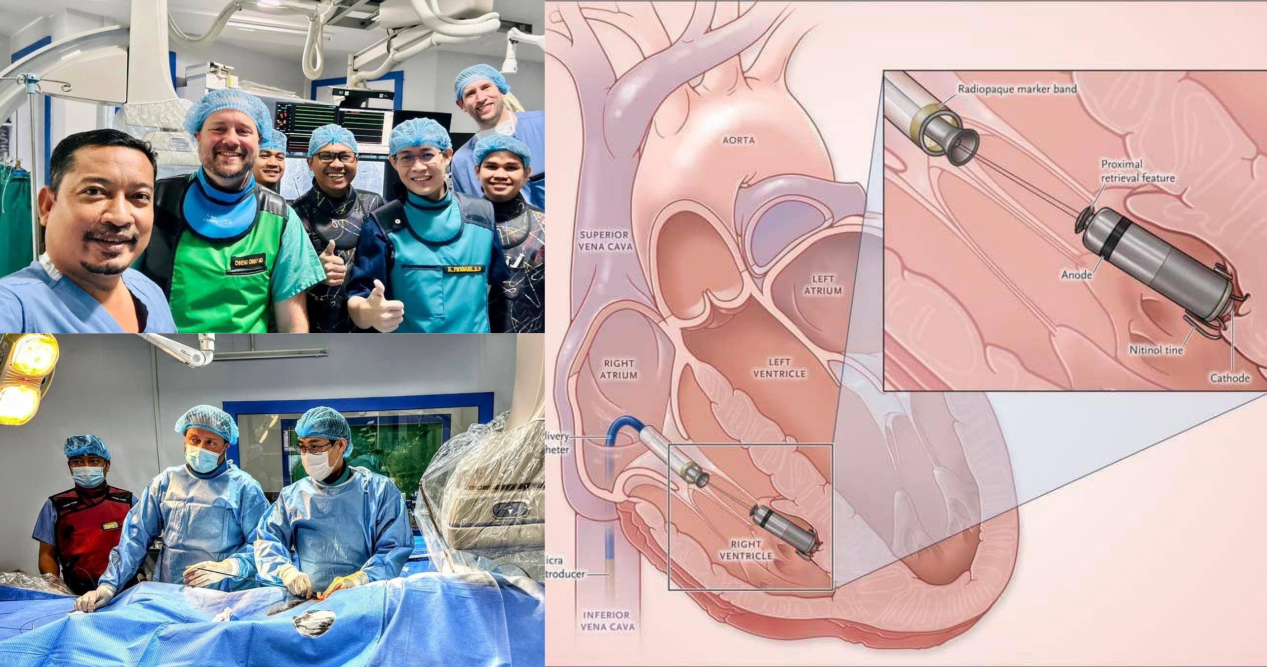 Micar Pacemaker ជាករណីលើកដំបូងទី ១ ...